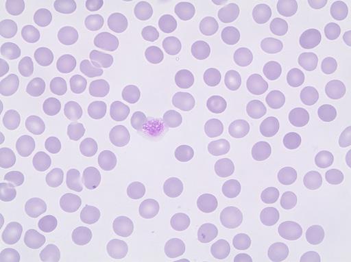 Platelet case studies Thrombocytopenia Diagnosis: Immune thrombocytopenia, ITP Case E04 This man has experienced several episodes of immune thrombocytopenia (ITP) from 1981 when he was 27 years old.