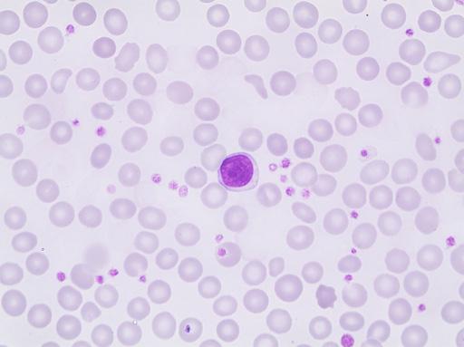Platelet case studies Case E05 Thrombocytosis Diagnosis: Anemia of iron deficiency (with thrombocytosis) A baby boy (8 months old) had gastroenteritis during the spring 2014 when blood tests revealed
