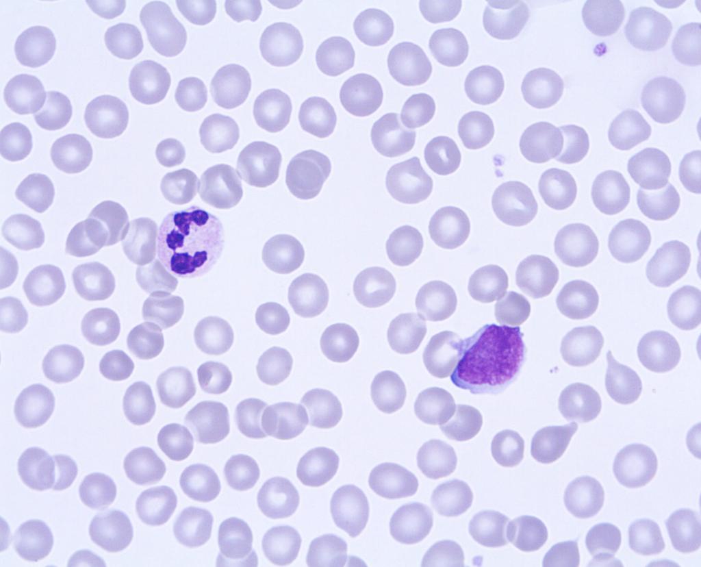 Acute Leukemias Acute leukemia Diagnosis: T lymphoblastic leukemia, T-ALL Case F04 A woman, 73 years of age, who lately was diagnosed with small vessel vasculitis.