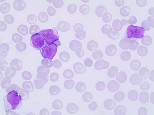 Acute Leukemias Case F06 Blasts Diagnosis: T lymphoblastic leukemia, T-ALL This serious case involves a 51-year-old man with a complicated background of ulcerative colitis and sclerosing cholangitis