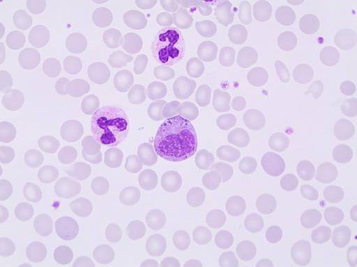 Chronich myeloproliferative diseases Leukocytosis Diagnosis: Chronic myelogenous leukemia, BCR-ABL1 positive, CML Case G05 A 46-year-old man who works with X-ray of horses.