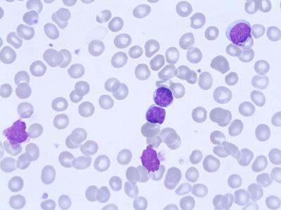 Lymphomas Case H07 Lymphocytosis Diagnosis: Chronic lymphocytic leukemia, CLL This 80-year-old lady was treated for chronic lymphocytic leukemia with four courses of fludarabine and cyclophosphamide