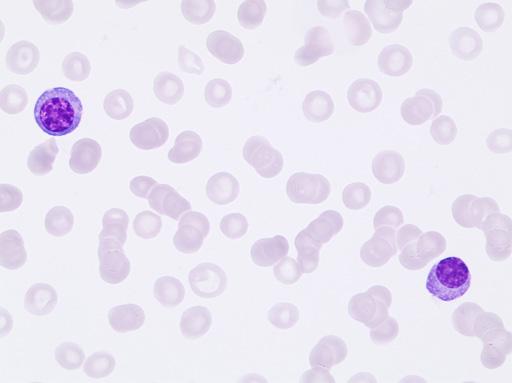 Pathological counts Case B15 Plasma cells Diagnosis: Plasma cell leukemia This woman was initially followed from 1997 without treatment for smouldering myeloma with M-protein IgA-kappa and Bence