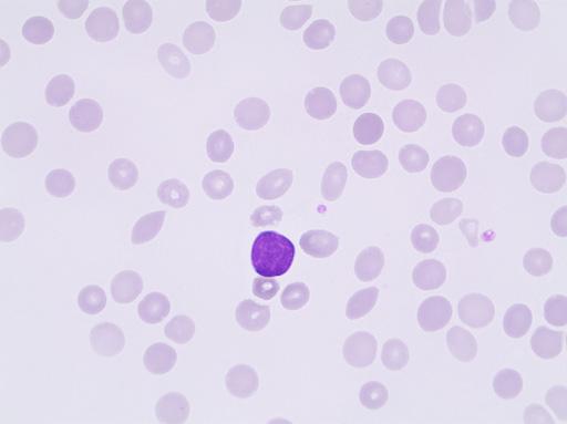 Lymphomas Lymphocytosis Diagnosis: Waldenström macroglobulinemia, WM Case H13 Here is a 56-year-old male car mechanic whose physical capacity has decreased dramatically during the last 6 months.