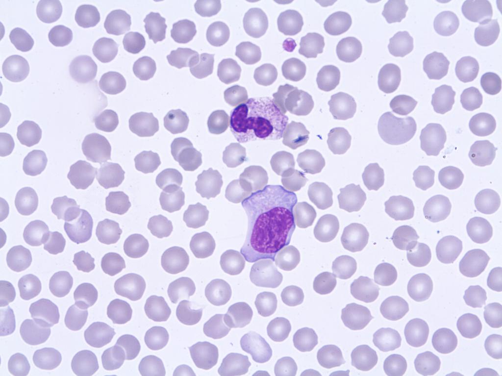 Infections Case C05 Variant lymphocytes Diagnosis: Tonsillitis mononucleosis A 5-year old boy with tonsillitis due to a primary EBV infection (EBV serology positive for IgG and IgM).