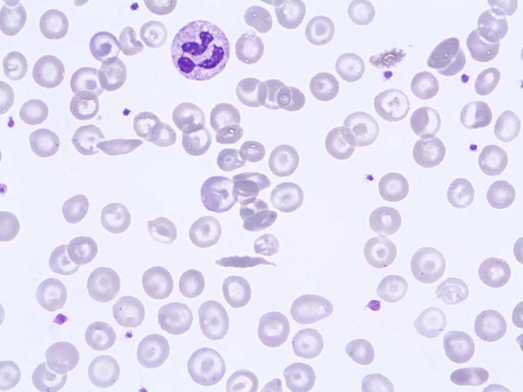 Erythrocyte case studies /Anemia Anemia Diagnosis: Sickle cell anemia Case D14 A 30-year old man who is a homozygote for sickle cell anemia.