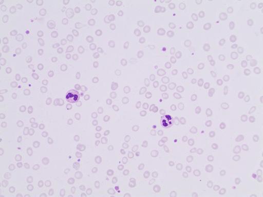 Erythrocyte case studies /Anemia Microcytosis Case D18a Diagnosis: Anemia of iron deficiency Here is a male teenager (16 years of age) who has been healthy and engaged in sports besides going to