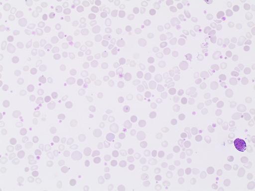 Erythrocyte case studies /Anemia Case D18b Microcytosis, dimorphic picture (continued from previous case) Diagnosis: Anemia of iron deficiency He received three units of packed red cells and started