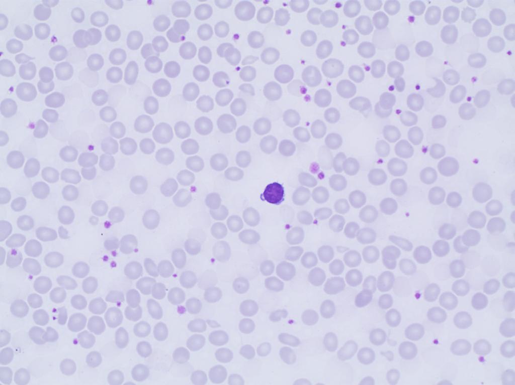 Erythrocyte case studies /Anemia Erythrocyte abnormalities Case D19 Diagnosis: Anemia of iron deficiency A 5-year old boy was admitted to hospital due to 3-4 days of low-grade fever and epigastric