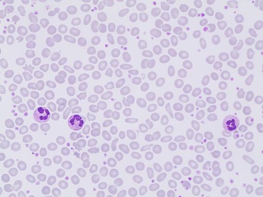 Erythrocyte case studies /Anemia Ovalocytosis Case D20 Diagnosis: Secondary thrombocytosis and leukocytosis (carcinoid tumor) This 82-year-old woman was operated by hemicolectomy for an ileocecal