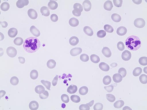 Erythrocyte case studies /Anemia Macrocytosis Case D21a Diagnosis: Anemia of folic acid deficiency This now 50-year-old man has abused alcohol periodically since his youth, but has been able to work