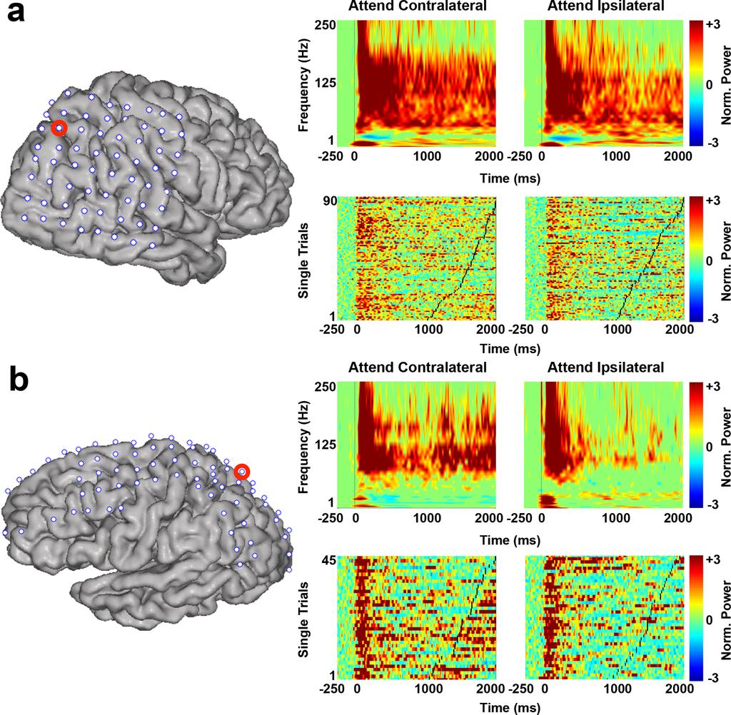 Phase-Amplitude Coupling in Human Fronto-Parietal Cortex Figure 2. HG power changes track attentional allocation.