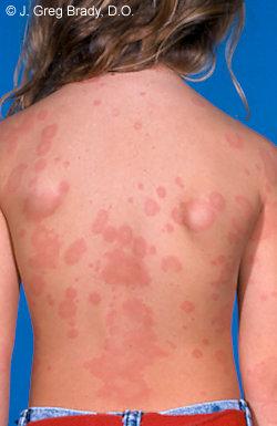 URTICARIA Condition in which eruptions of wheals or hives occur most often in response to an allergen Most common cause is a Type I
