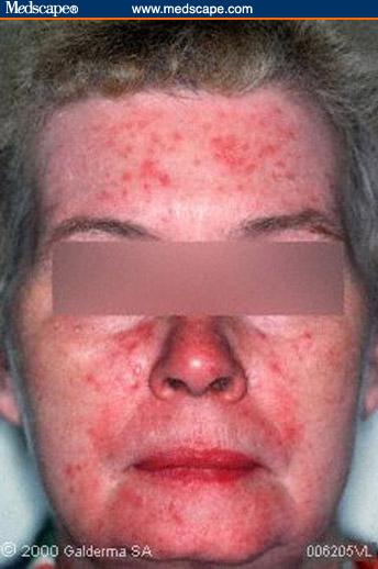 ACNE ROSACEA More common in middle age to older adult Causes changes in skin color,