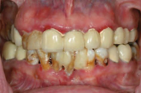 Clinical Figure 1: Starting situation: The remaining teeth were found to be affected by periodontal disease.