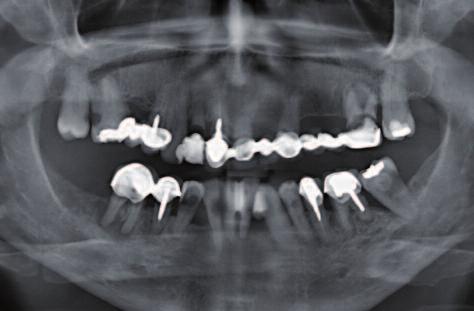 Figure 3: Following extraction of the remaining teeth, the immediate dentures (fabricated with the BPS system) were incorporated. Figure 4: The provisional dentures in situ.