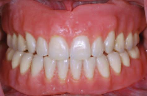 She was unhappy with the esthetic appearance of her dentures as well as their masticatory function.