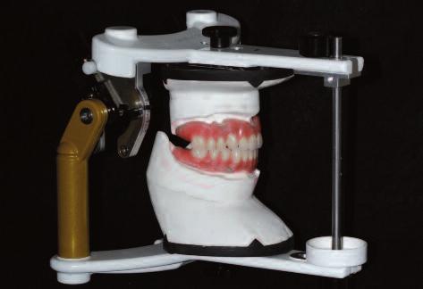 Figure 5: Planning of the surgical intervention. The superposed image of the immediate denture formed the basis for the correct placement of the implants.