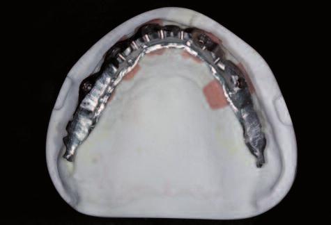 Figure 8: CAD/CAM-fabricated titanium framework for the upper jaw. BPS as a planning tool in computer-assisted oral surgery A cone beam CT scan was carried out.