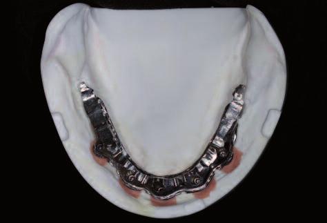Figure 9: CAD/CAM-fabricated titanium framework for the lower jaw. Figure 10: The completed dentures ready for final incorporation in the mouth. 3.