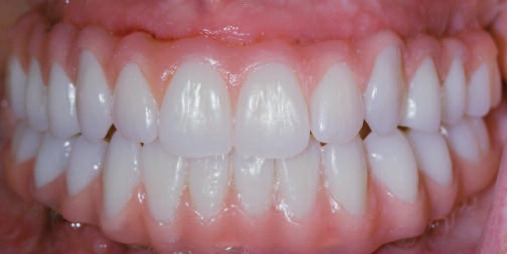 Furthermore, an esthetic transition between the teeth and the adjacent soft tissue portions is created (Figure 10). 4.