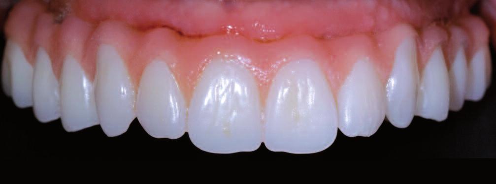 Figure 12: Excellent esthetic integration of the denture teeth (SR Phonares NHC) as well as of the soft tissue portions into the natural environment.