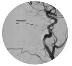 Intervention Endovascular coil embolization was done with obliteration of the dural arteriovenous fistula and resolution of facial pain but with decreased sensation in the face Pre-embolization