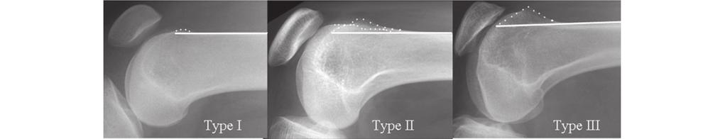 T.O. Smith et al. / The Knee 20 S1 (2013) S3 S15 S7 Fig. 3. Lateral radiographs showing the three types of trochlear dysplasia using the Dejour classification. of dysplasia, such as patella alta.