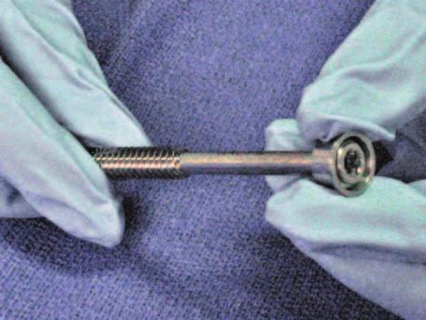 In the event of a Head Plunge, the washers can be used to salvage screw fixation.