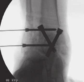 Ankle Fusion Hodges Davis, MD When performing an ankle fusion I find it most successful to drill under power across the joint to approximately 5mm before the end of the guide wire.