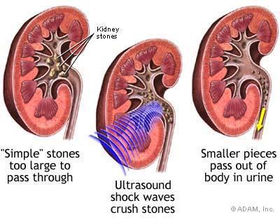 Kidney Stones Extracorporeal shock wave lithotripsy (ultrasonic