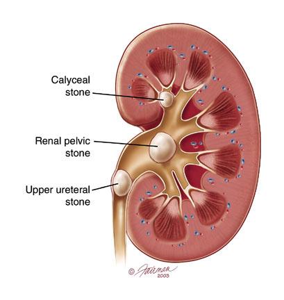 Kidney Disorders and Diseases Kidney Stones Very painful Can shutdown kidneys