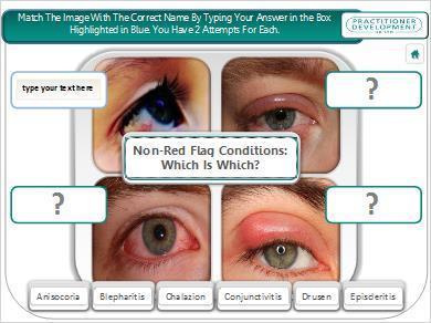 Serious Sub-Conjunctival Haemorrhages: Bruising may be evident If no demarcation line, then refer to A&E SEIOUS SUB-CONJUNCTIVAL HAEMORRHAGES Non-Red Flag Conditions Game: A: B: C: D: ANSWERS