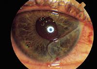 Corneal Laceration Small full or partial thickness lacerations may generally