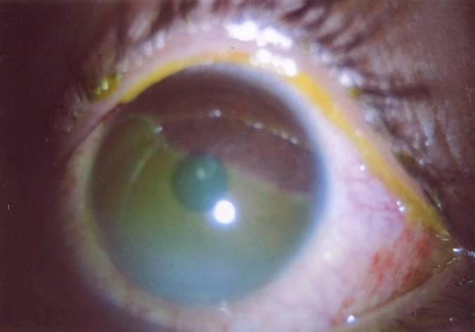 This is Blood under the conjunctiva, and is usually unilateral, localised and sharply circumscribed; the underlying sclera is often not