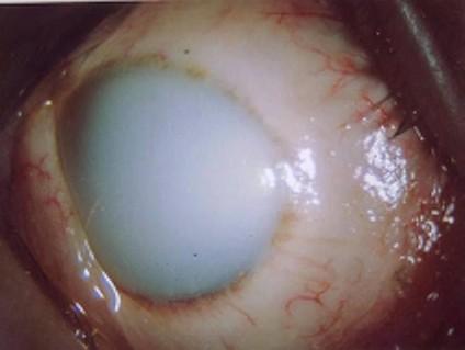 Signs include corneal haze, limbal ischaemia and loss of epithelium. Management: An acute ocular emergency.