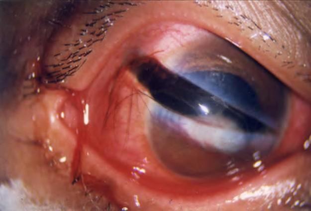 This results from severe blunt trauma and perforating ocular trauma.