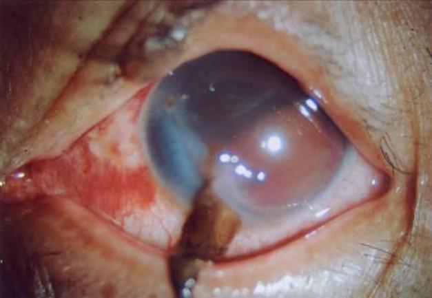 The perforated eye is prone to infection (endophthalmitis).