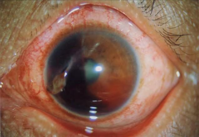 Hyphaema Mild Severe Blood in the anterior chamber following blunt trauma to the eye.
