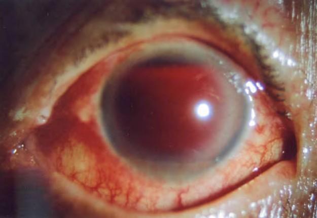 Eye may be very sore if intraocular pressure is raised. Haematocornea causes cloudy vision.