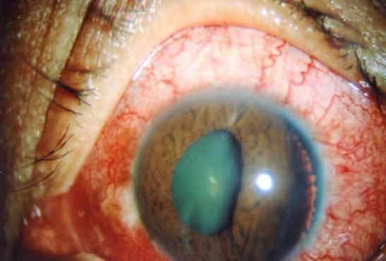 Iridodialysis A dehiscence of the iris from the ciliary
