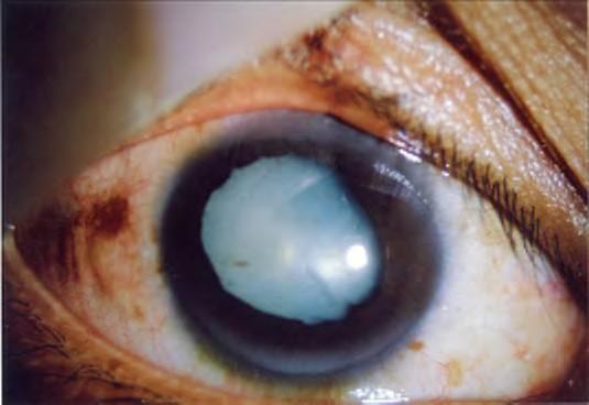 Cataract Traumatic cataract may arise from direct penetrating