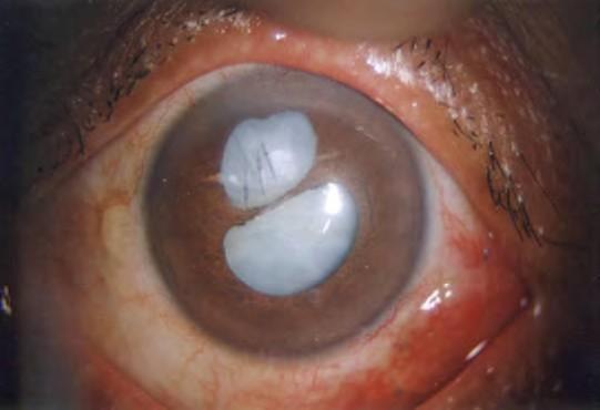 Concussion may cause an imprinting of iris pigment onto the