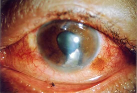 Direct trauma to the eye may result in lens subluxation or total