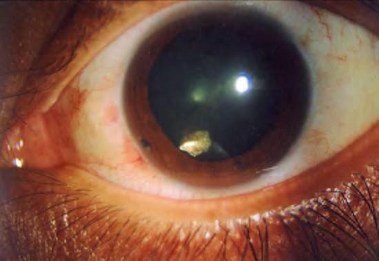 Victims may experience reduced vision, monocular diplopia and intraocular