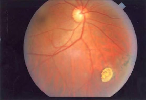 Vitreous/ retina An IOFB may lodge in any of the ocular structures it passes through, so may be located anywhere from the anterior chamber, lens to