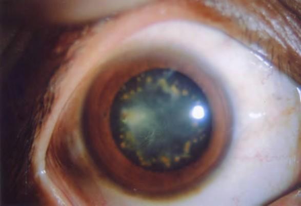 Management: immediate referral to ophthalmologist for removal of foreign body.