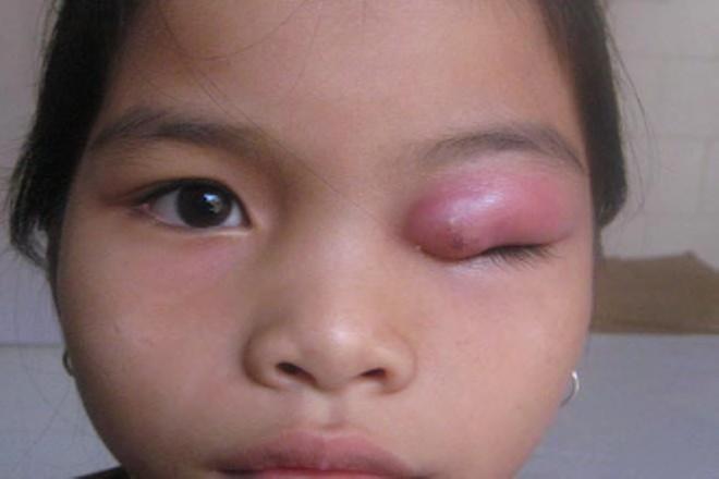 Inflammation of the meibomian glands causes lumps in the eyelids. Signs: eyelid swelling, redness and pain.