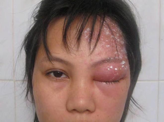 Ophthalmic zoster (shingles) A painful condition caused by Herpes zoster infection.