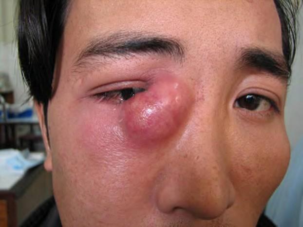 Dacryocystitis Infection of the lacrimal sac usually secondary to obstruction of